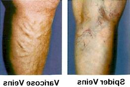 spider and varicose veins